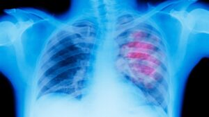 Questo segno poco conosciuto di cancro ai polmoni dovrebbe avvisarti