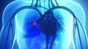 Come si forma un’embolia polmonare? I fattori di rischio da conoscere