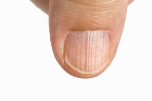 Hai le unghie striate? Scopri ora cosa significa