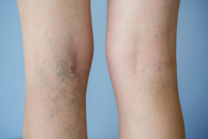 Malattia venosa cronica: sintomi, cause e diagnosi