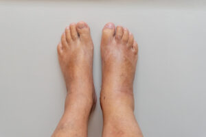 Piedi gonfi in estate, quali sono le cause più comuni?