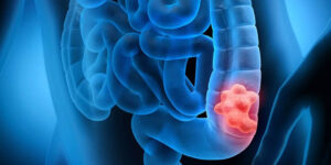 Tumore al colon under 50: lo studio che cambia i fattori di rischio noti