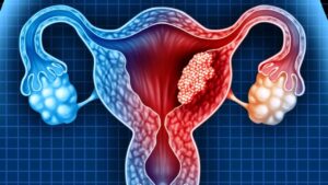 Ascite e carcinoma ovarico: la ricerca rivela un nuovo nemico