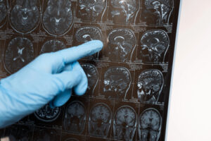 La demenza può iniziare a danneggiare la memoria già a 20 anni