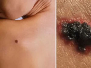 Cos’è il melanoma e perché è così pericoloso?