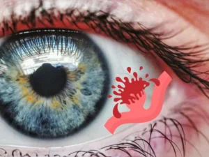 Emorragia sottocongiuntivale: quando una macchia rossa nell’occhio è innocua e quando no