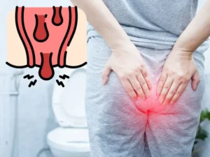 Emorroidi trombizzate: sintomi, cure e prevenzione per un benessere completo