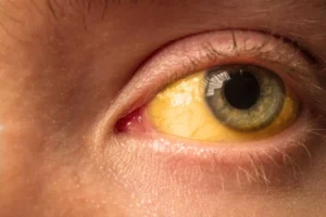 Epatite: la verità sui contagi e come difendersi