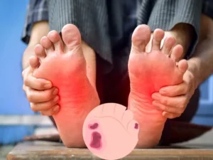 Piede diabetico: sintomi, rischi e prevenzione quotidiana