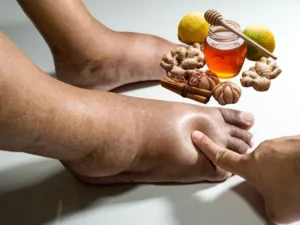 Piedi gonfi: cosa li provoca davvero e 3 rimedi naturali che puoi fare a casa
