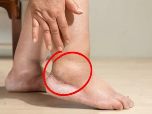 Perché si gonfiano piedi e caviglie a fine giornata? Le cause e cosa fare