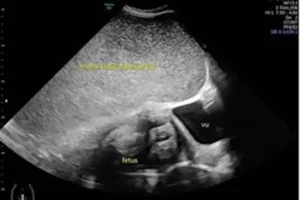 Cisti gigante scoperta al nono mese: salvati mamma e bambino
