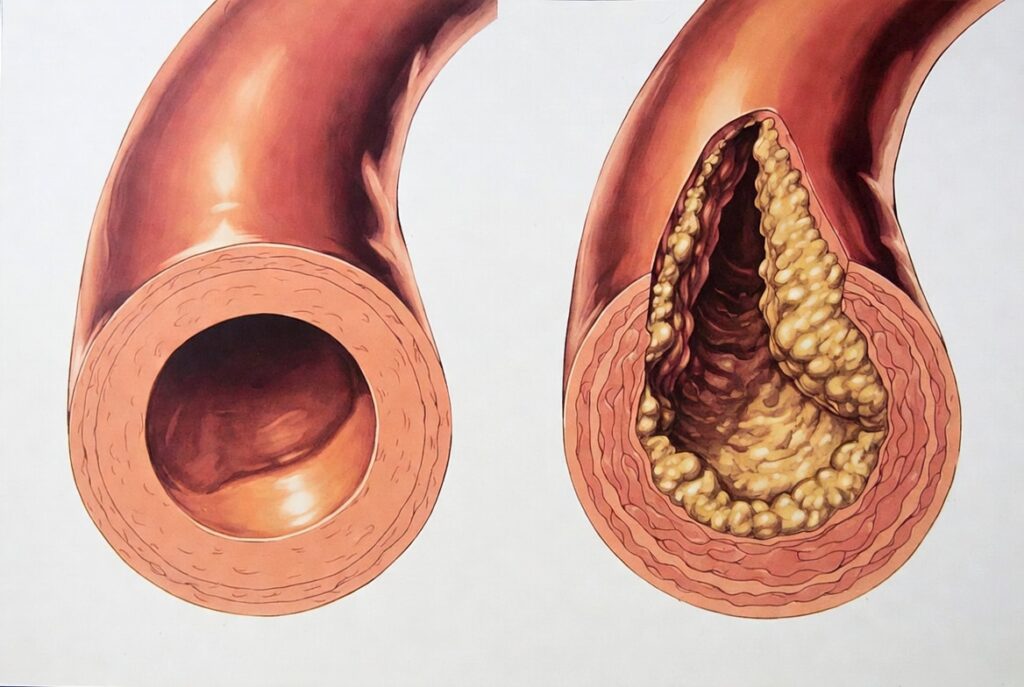 Arteriosclerosi: i sintomi tardivi che possono salvarti la vita