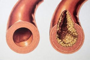 Arteriosclerosi: i sintomi tardivi che possono salvarti la vita