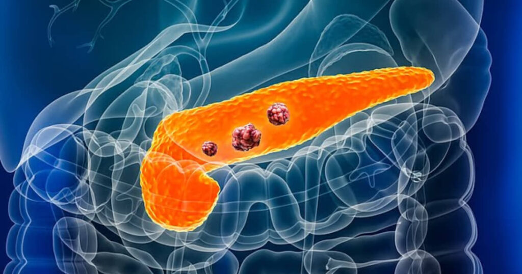 Tumore al pancreas, scoperto un segnale anni prima dei sintomi: cosa succede nel corpo