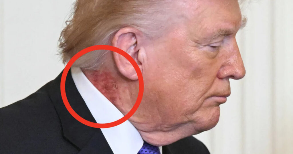 Macchia rossa sul collo di Trump: di cosa si tratta?