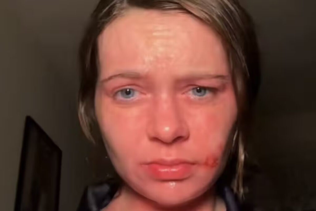 “Il sole mi fa bruciare la pelle”: la malattia rara che ha cambiato la vita di Jennifer