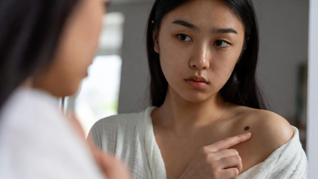 Melanoma, i sintomi nascosti che possono salvarti la vita