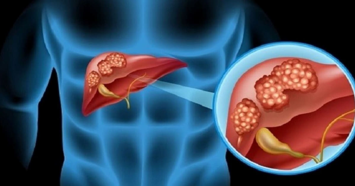 Cancro al pancreas: ecco i 7 sintomi da non ignorare